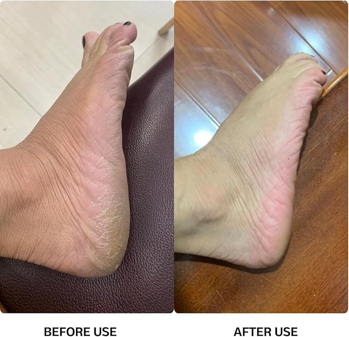 Electric callus remover, foot sander, enhanced pedicure tool with speed controller and 60 spare sanding discs for men and women, removes calluses, dead and dry skin, pink and black color.