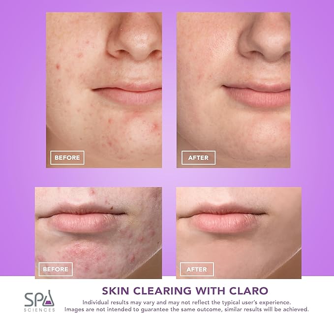 Spa Sciences CLARO Clinically Proven Blue & Red LED Acne Treatment Light Therapy System-FDA Cleared-Rechargeable- Professional Home Acne Healing/Clearing Treatment