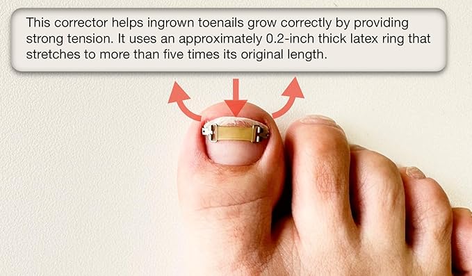 [XS/0.63inches/15-17mm] Ingrown toenail treatment by latex ring elasticity, usable in everyday life, Ingrown toenail corrector, Yellow/Silver