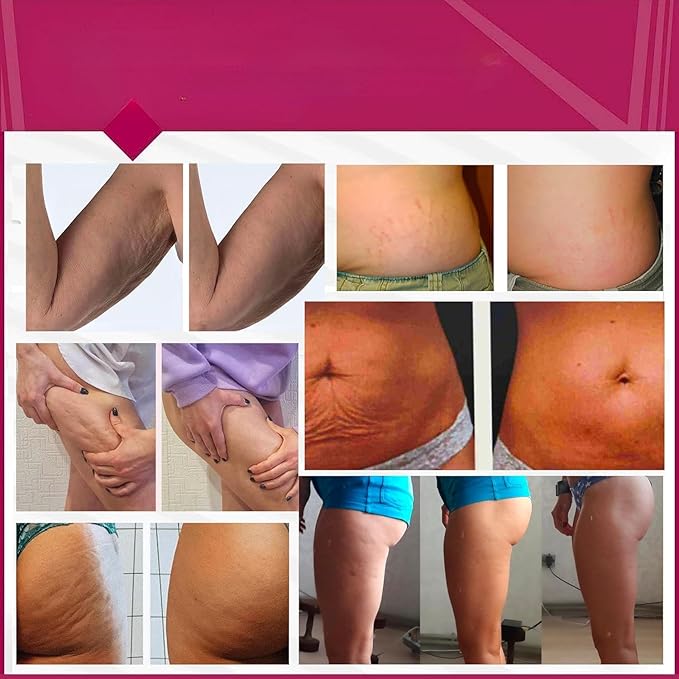 Anti-Cellulite Advanced Hot Body Cream Gel For Even Skin and Elasticity. Anacis - 5.07 Oz