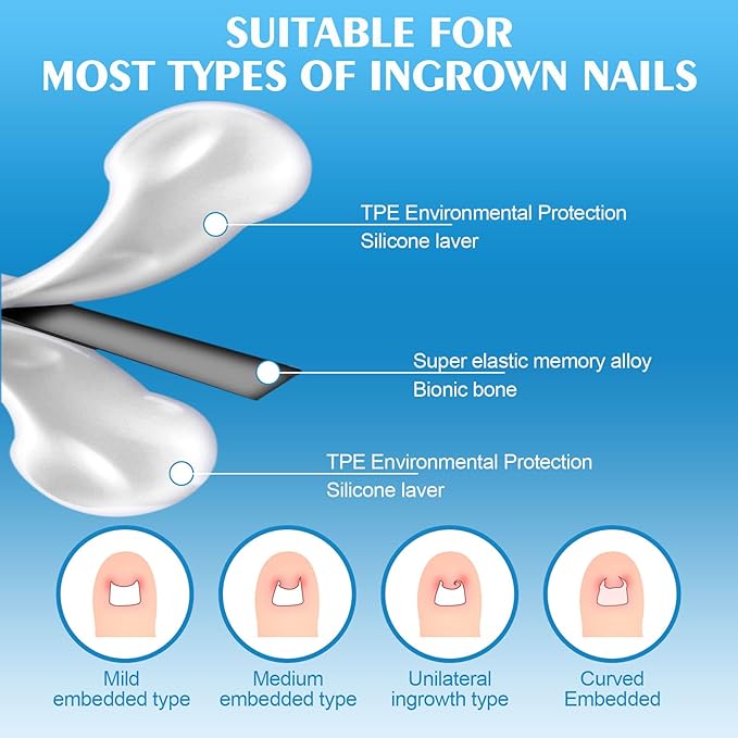 Titanium Alloy Silicone Ingrown Toenail Treatmen,Ingrown Toenail Removal Ingrown Toenail Removal Kit ngrown Toenail Removal Kit,Designed for Curved Nail Repair,Ingrown Toenail (0.67-0.79in)