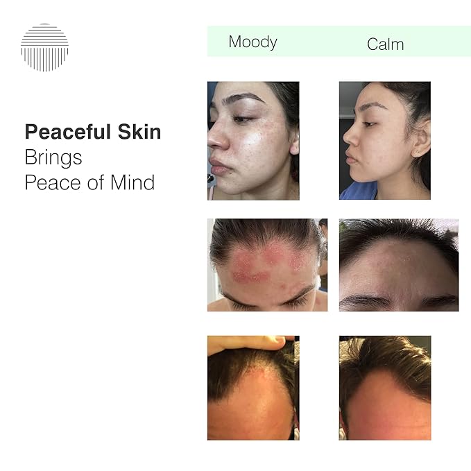 Calming Seborrheic Serum, Dermatologist Recommended, Topical Serum For Hair, Face, and Body (4oz)