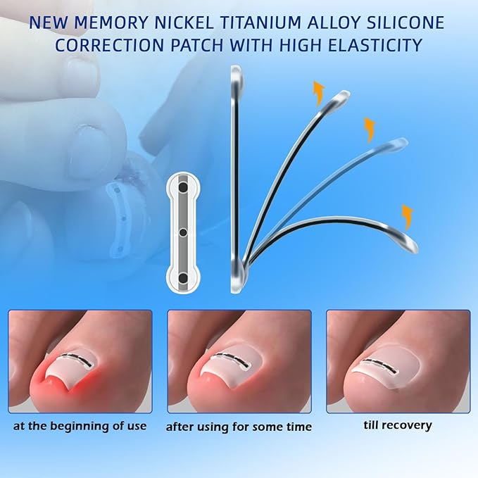 Titanium Alloy Silicone Ingrown Toenail Treatment, correction patch, Ingrown Toenail Corrector, Nail correction tool,Ingrown Toenail Removal Kit,Cuttable Applicable for any nail size,Reusable