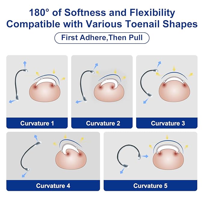 Nitinol Ingrown Toenail Corrector,at Home Ingrown Toenail Treatment,Curved Toenail Straightener,Ingrown Toe Nail Relief，Ingrown Toenail Removal Kit (11/16 In,13/16 In)