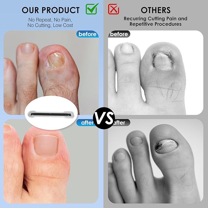 Titanium Alloy Ingrown Toenail Treatment, Ingrown Toenail Removal Kit Specially Designed for Curved Nail Repair and Ingrown Toenail Corrector Kit