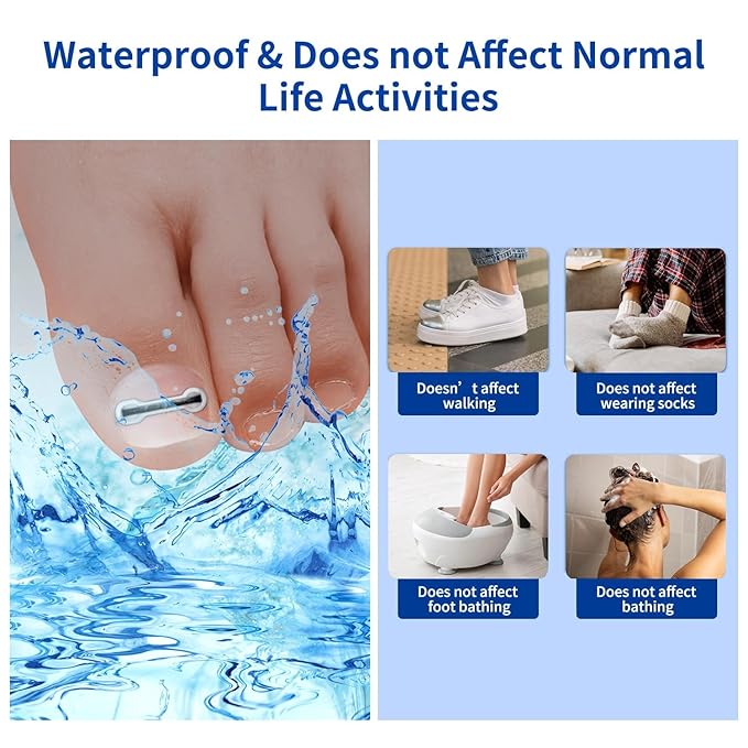 Ingrown Toenail Treatment, 10 packs Titanium Alloy Ingrown Toenail Corrector for all size foot, Ingrown Toenail Removal Kit for Curved Nail Repair, at Home Nail Kit Tools-S01