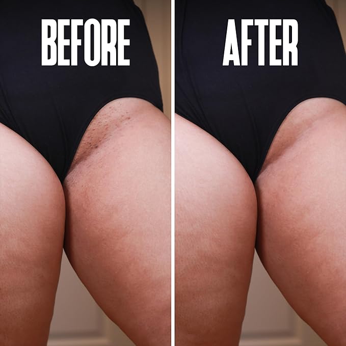 Prevent Ingrown Hairs and Razor Bumps with BHA & AHA Pads - Ingrown Hair Serum for Razor Burns - PFB Razor Bump Stopper Topicals Skin Care, Ingrown Hair Treatment for Bikini Area and Razor Bumps