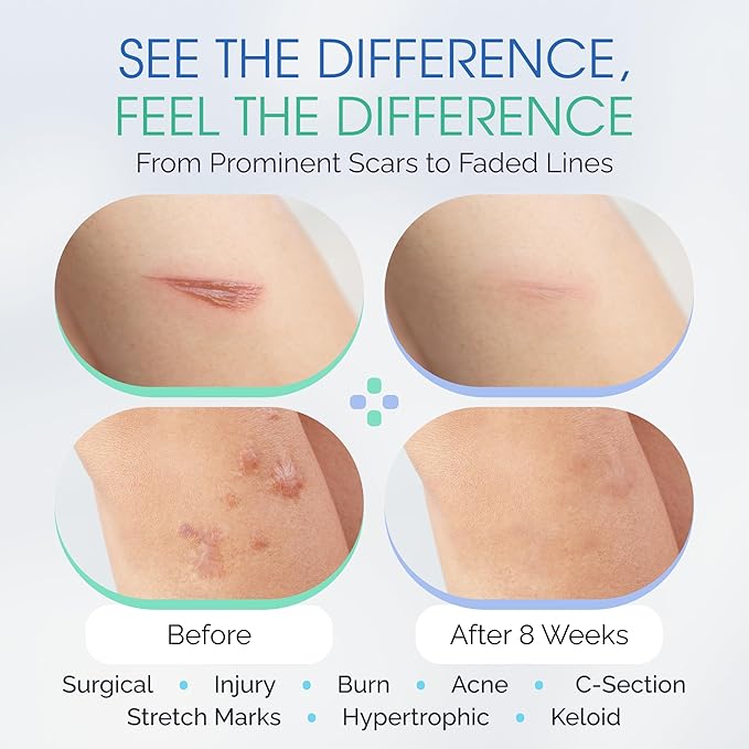 Brush On Medical Grade Silicone Scar Gel XL Wand for Body and Facial Scars, Hypoallergenic Silicone Scar Gel for Surgical Scars and Post-Cosmetic Procedures, 18 mL