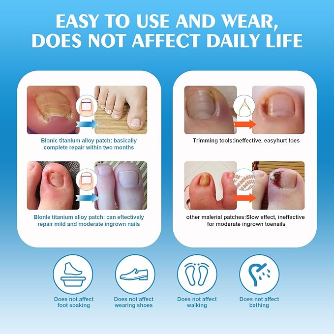 Titanium Alloy Silicone Ingrown Toenail Treatmen,Ingrown Toenail Removal Ingrown Toenail Removal Kit ngrown Toenail Removal Kit,Designed for Curved Nail Repair,Ingrown Toenail (0.67-0.79in)