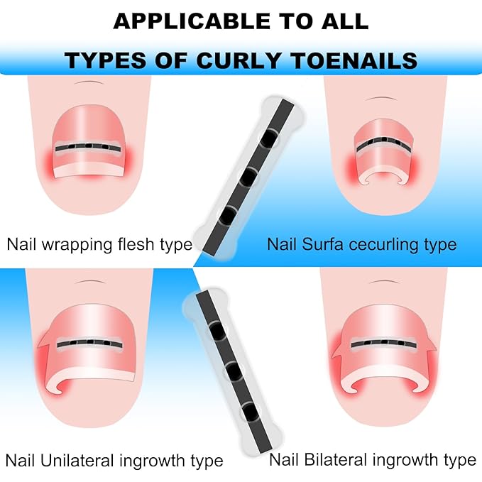 Upgraded ingrown toenail treatment, nail kit, Ingrown Toenail Treatment, Ingrown Toenail Removal Kit, Designed for Curved Nail Repair, Ingrown Toenail Corrector, Suitable for many types of correction.