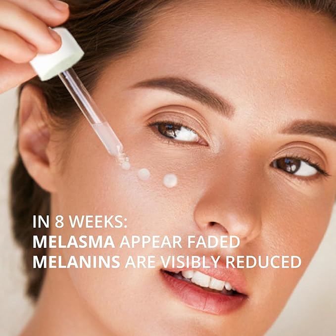 Abera Melasma Serum Plus, Melasma Treatment for Face, Dark Spot Corrector Serum, Melasma Dark Spot Remover, Sun Spot, Age Spot, Brown Spot Remover for Men, Women (1 FL OZ)