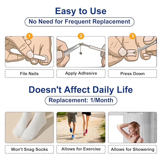 Nitinol Ingrown Toenail Corrector,at Home Ingrown Toenail Treatment,Curved Toenail Straightener,Ingrown Toe Nail Relief，Ingrown Toenail Removal Kit (1/2 In,11/16 In)