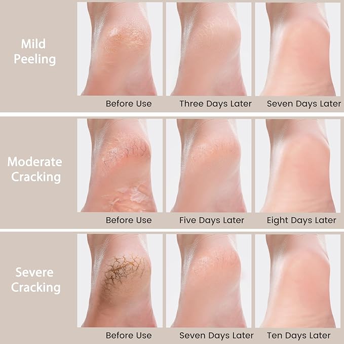 2 Packs Urea Cream 40 Percent - Foot & Hand Cream, for Dry, Cracked Heels, Feet, Knees, Elbows, and Hands, Callus Remover, Maximum Strength Urea Lotion for Softening and Moisturizing