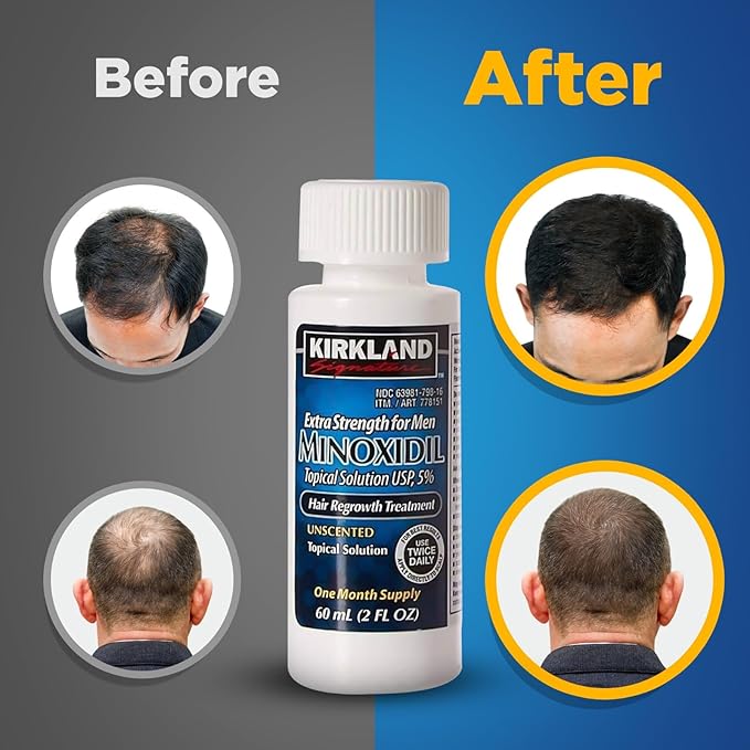 Kirkland Signature 5% Minoxidil Hair Regrowth for Men - 1 Month Supply