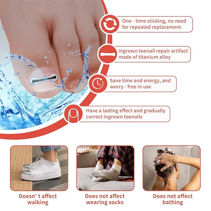 Ingrown Toenail Treatment, 10 packs Titanium Alloy Ingrown Toenail Corrector for all size foot, Ingrown Toenail Removal Kit for Curved Nail Repair, at Home Nail Kit Tools-Q03