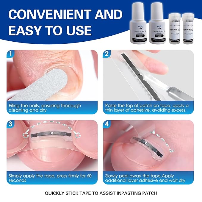 Titanium Alloy Ingrown Toenail Treatment, Nail Tools, and Ingrown Toenail Removal Kit Specially Designed for Curved Nail Repair and Ingrown Toenail Corrector