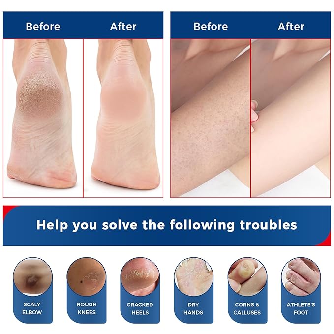 NEW FORMULA Urea Cream 40 Percent for Feet Maximum Strength, Hand Heels Dry Cracked Treatment Lotion for Knees & Elbows, Foot Dead Skin Cuticle Callus Remover Toenail Softener, 5.29 oz