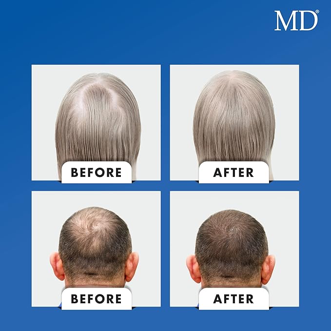 Nutri Hair Growth Supplement con biotina (30 cápsulas) | Previene la caída del cabello, minimiza la caída del cabello, el adelgazamiento, la rotura y promueve el cabello más largo y grueso | Formul