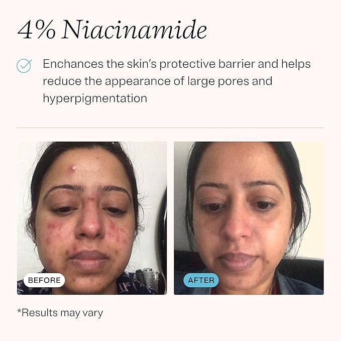 MDacne – Retinol 0.5% and Niacinamide 4% Cream, Reduces Blemishes and Improves Skin Texture without Irritation