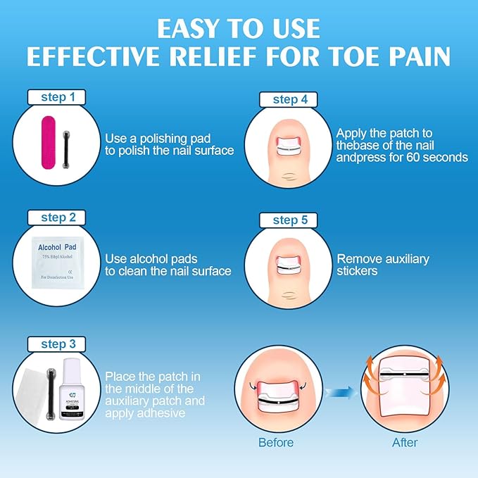 Titanium Alloy Silicone Ingrown Toenail Treatmen,Ingrown Toenail Removal Ingrown Toenail Removal Kit ngrown Toenail Removal Kit,Designed for Curved Nail Repair,Ingrown Toenail (0.67-0.79in)