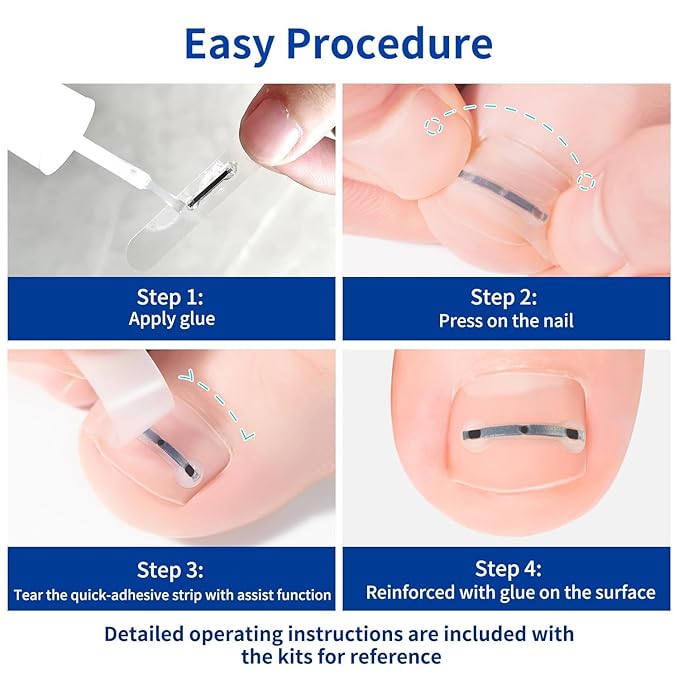 Ingrown Toenail Treatment, 10 packs Titanium Alloy Ingrown Toenail Corrector for all size foot, Ingrown Toenail Removal Kit for Curved Nail Repair, at Home Nail Kit Tools-S01