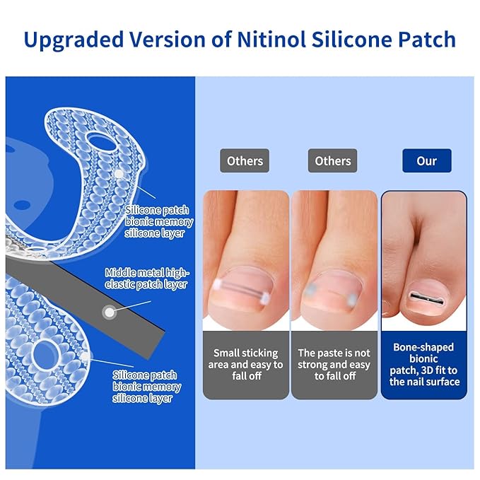 Ingrown Toenail Treatment, 10 packs Titanium Alloy Ingrown Toenail Corrector for all size foot, Ingrown Toenail Removal Kit for Curved Nail Repair, at Home Nail Kit Tools-Blue3