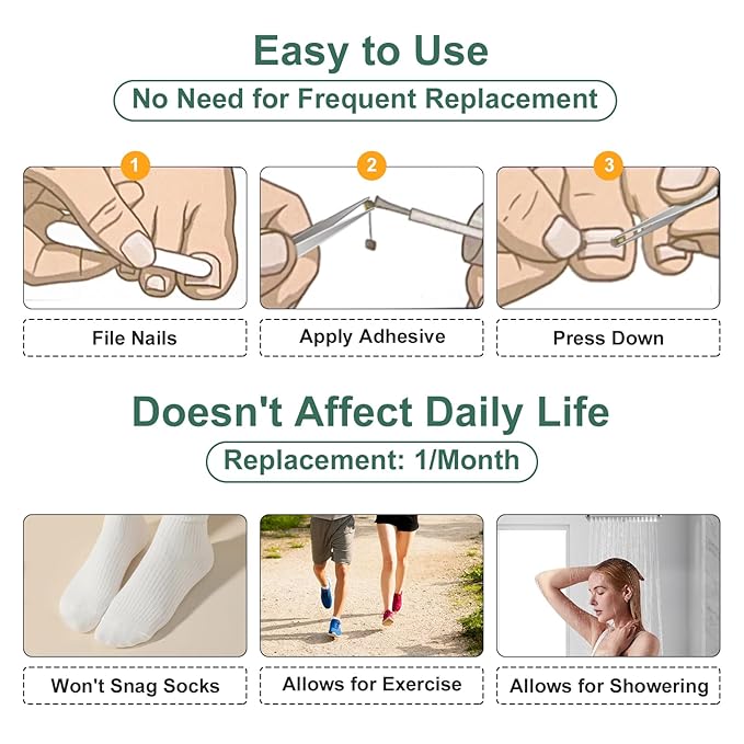 Dual Nitinol Ingrown Toenail Corrector,Ingrown Toenail Treatment,Curved Toenail Straightener,Ingrown Toe Nail Relief,Ingrown Toenail Removal Kit,Big Toe Ingrown Toenail Tool (0.55in,0.66in)