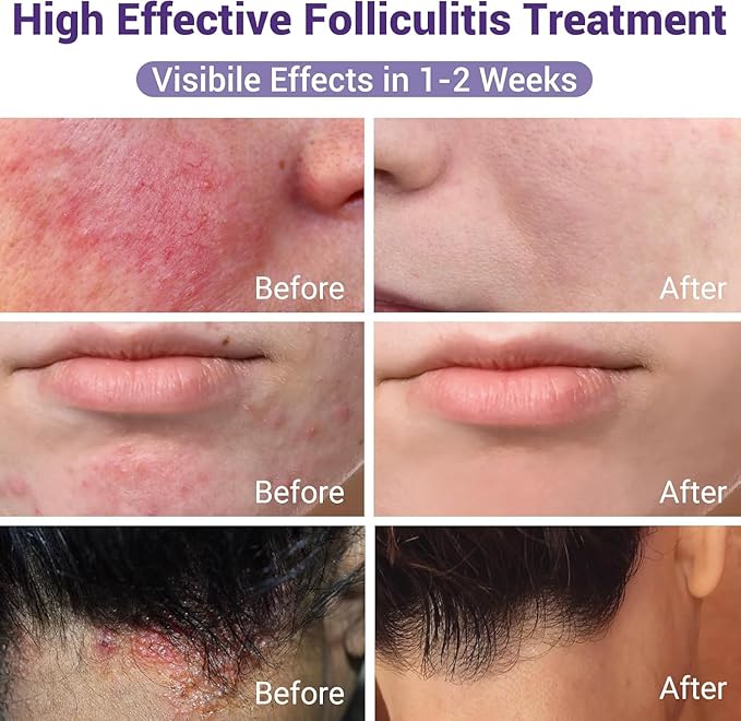 Folliculitis Treatment, Highly Effective Folliculitis Cream, Natural folliculitis for Itching, Redness, Inflammation, Ache, Burning, 3.53 Oz