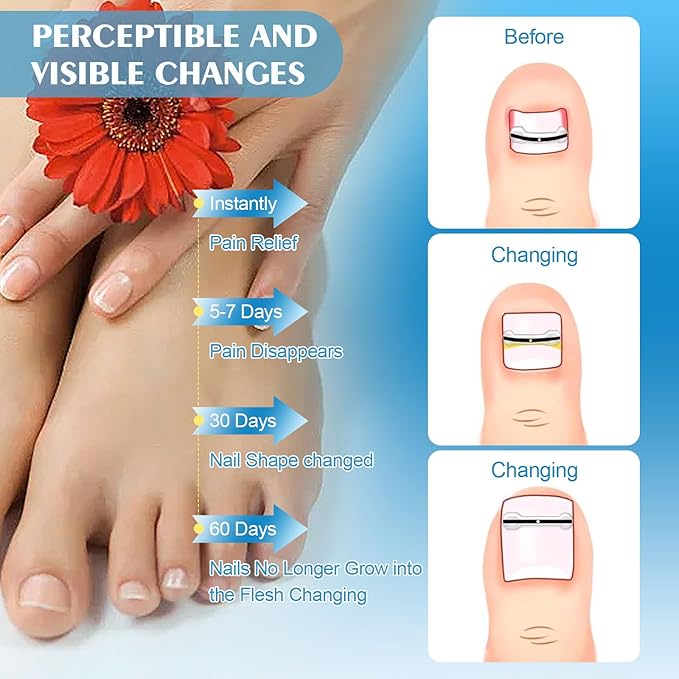 Titanium Alloy Silicone Ingrown Toenail Treatmen,Ingrown Toenail Removal Ingrown Toenail Removal Kit ngrown Toenail Removal Kit,Designed for Curved Nail Repair,Ingrown Toenail (0.67-0.79in)