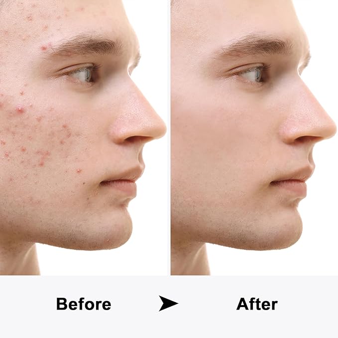 LED Acne Foe - Acne Spot Pimple Zit Treatment Device Red and Blue Light Therapy for Face, Facial Aesthetic Device, Blue