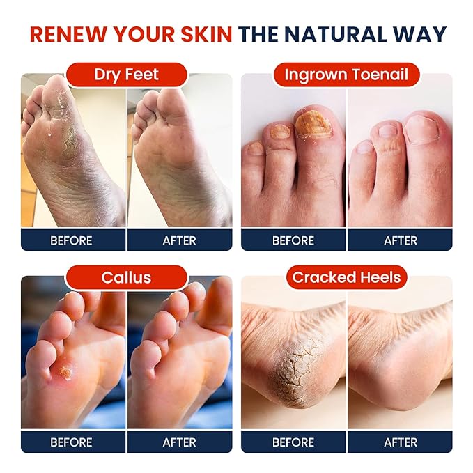 Muscle Relief Foot Soak with Epsom Salts & Tea Tree Oil Foot Balm - Moisturizing Athletes Foot Care Balm for Dry Cracked Feet