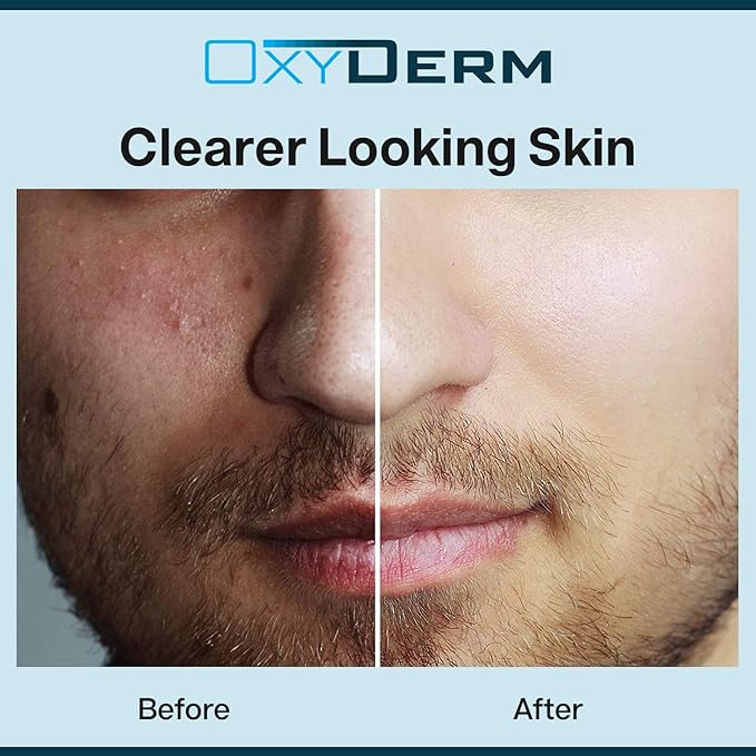 Sulfur Purifying Clay Mask- Deep Pore Cleansing Treatment. Clears Away Acne Blemishes, Clogged Pores, Scars, Oily Skin, Whitehead & Blackhead Pimples for Face & Body with Natural Healing.