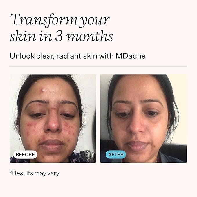 MDacne Salicylic Acid 2.0% - Acne Treatment Cream, Facial Exfoliant Unclog Pores, Prevents Blemishes, Blackheads, Wrinkles & Fine Lines, Reduce Irritation for Sensitive Acne-Prone Skin (1 Pack)