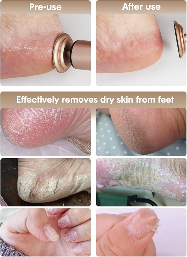 Electric Foot Callus Remover - 2 in 1 Cordless Electric Foot File Nail Grinder,Electric Callus Remover for Feet with 3 Modes,Dry Skin Remover for Feet (Rose Gold)