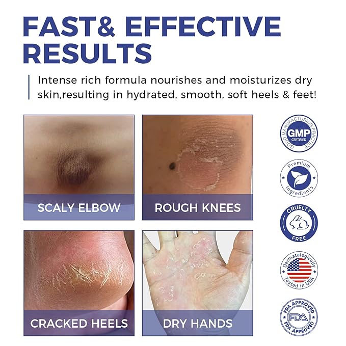 Urea Cream 42% plus Salicylic Acid 2% Intensive Repair Treatment for Cracked Skin on Hands, Heels, Elbows, and Lips - Relief for Dry Feet - Enhanced Pump Dispenser Packaging - Gross wt 8.03 OZ