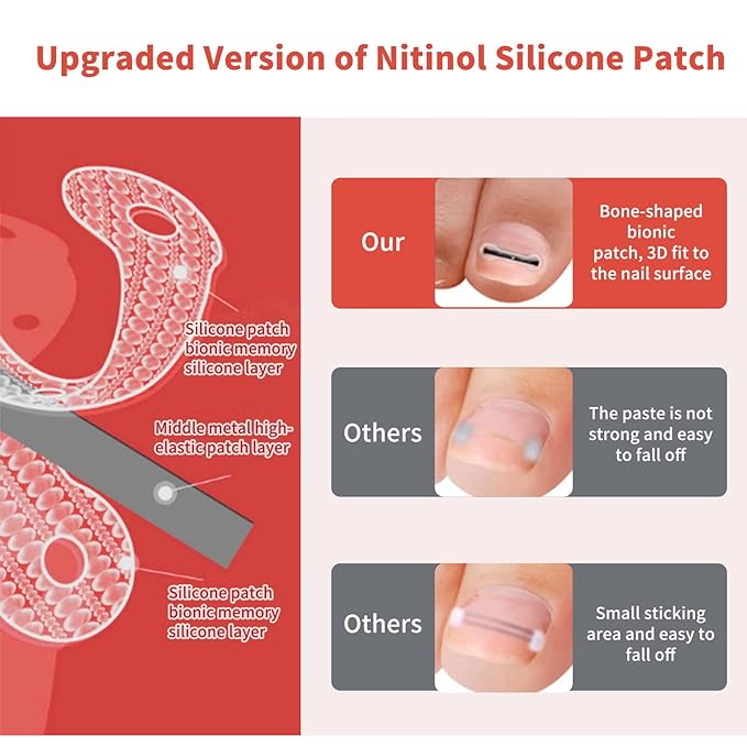 Ingrown Toenail Treatment, 10 packs Titanium Alloy Ingrown Toenail Corrector for all size foot, Ingrown Toenail Removal Kit for Curved Nail Repair, at Home Nail Kit Tools-Q03