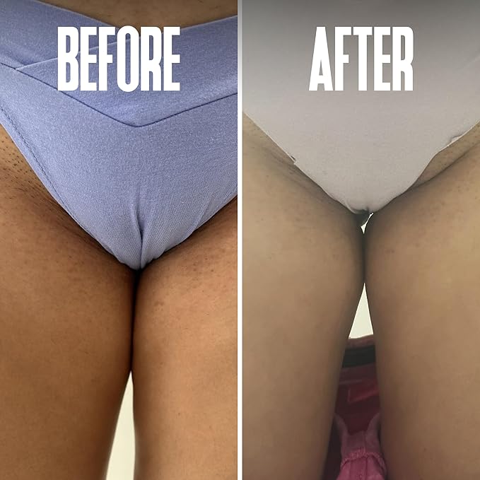 Prevent Ingrown Hairs and Razor Bumps with BHA & AHA Pads - Ingrown Hair Serum for Razor Burns - PFB Razor Bump Stopper Topicals Skin Care, Ingrown Hair Treatment for Bikini Area and Razor Bumps