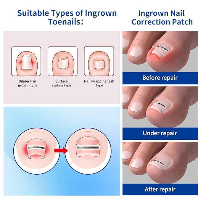 Ingrown Toenail Treatment, 10 packs Titanium Alloy Ingrown Toenail Corrector for all size foot, Ingrown Toenail Removal Kit for Curved Nail Repair, at Home Nail Kit Tools-S01