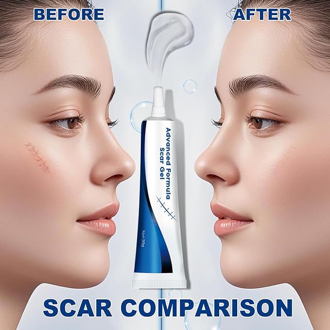 Advance Scar Gel, Scar Cream, Advanced Formula Scar Gel for Old & New Scars, Surgical Scars, Face, Body, Leg, Burns, Acene, C-Section, Stretch Marks, Keloids, Scar Removal for Adults & Kids