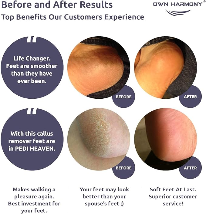 Own Harmony Electric Foot Callus Remover and 6 Rollers Bundle: Professional Foot Care Pedicure Tools, Rechargeable Dead Skin Feet Scrubber, Electronic Feet File Grinder - Best for Hard, Cracked Heels