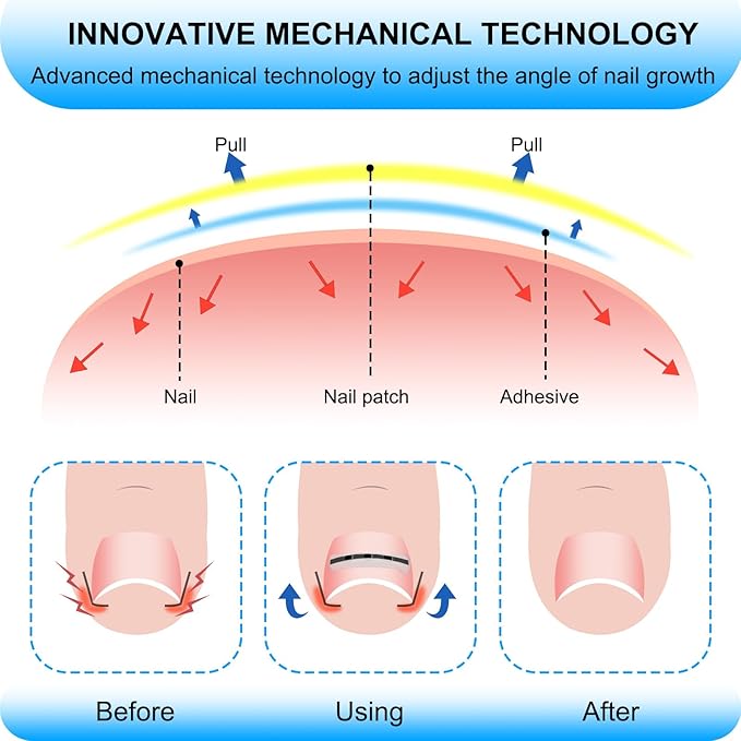 Upgraded ingrown toenail treatment, nail kit, Ingrown Toenail Treatment, Ingrown Toenail Removal Kit, Designed for Curved Nail Repair, Ingrown Toenail Corrector, Suitable for many types of correction.