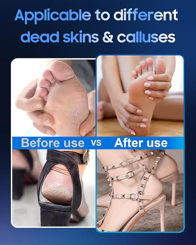 11000 RPM Rechargeable Electric Foot Callus Remover with 2Glass Sander Discs - Cordless Foot Scrubber,Professional Pedicure Tool for Dead Skin and Calluses,Electric Foot File - Blue