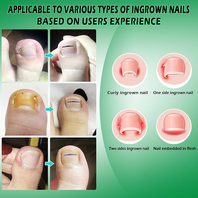 Titanium Alloy Silicone Ingrown Correction Tool Kit,Ingrown Toenail Treatment,Ingrown Toenail Removal Kit,Designed for Ingrown Nail Repair, nail Corrector, Cuttable Applicable to most sizes,reusable