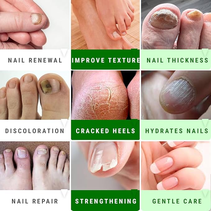 Urea Nail Gel - Softens Cracked Heel Calluses & Thick Toenails - Repairs Damaged, Yellow, Discolored Nails – Highly Effective & Quick-Dry Fingernails & Toenail Treatment (Urea 40%)