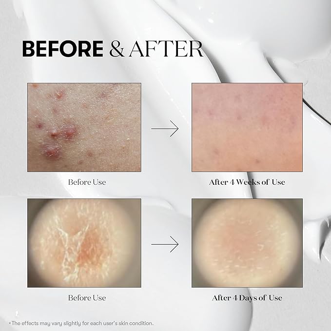 VT COSMETICS CICA Reedle Shot 50, Spicule Microneedling Serum for Pore Care & Exfoliation, Exosome, Centella Asiatica for Glass Skin, Smooth Texture, Korean Liquid Skin Booster (1.69 Fl Oz / 50ml)