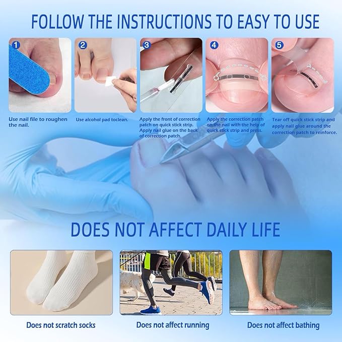 Titanium Alloy Silicone Ingrown Toenail Treatment, correction patch, Ingrown Toenail Corrector, Nail correction tool,Ingrown Toenail Removal Kit,Cuttable Applicable for any nail size,Reusable
