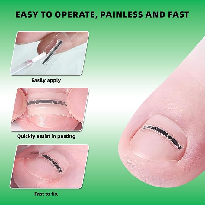 Ingrown Toenail Treatment, Nails Corrector Tool, Professional Toenail Correction Remover Repair Removal Kit for Rapid Relief