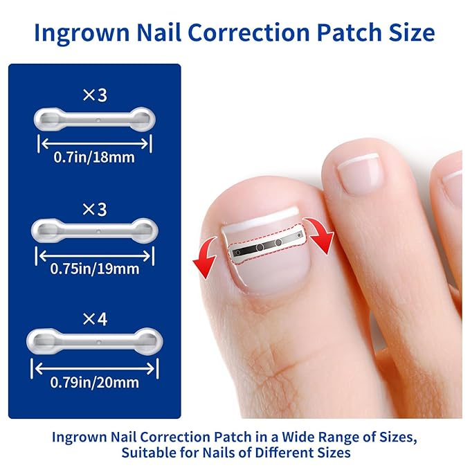 Ingrown Toenail Treatment, 10 packs Titanium Alloy Ingrown Toenail Corrector for all size foot, Ingrown Toenail Removal Kit for Curved Nail Repair, at Home Nail Kit Tools-Blue3