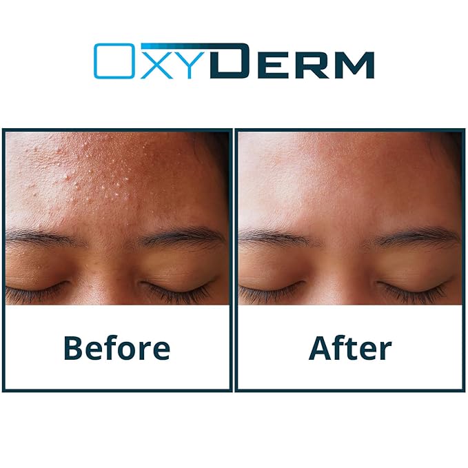 Sulfur Purifying Clay Mask- Deep Pore Cleansing Treatment. Clears Away Acne Blemishes, Clogged Pores, Scars, Oily Skin, Whitehead & Blackhead Pimples for Face & Body with Natural Healing.