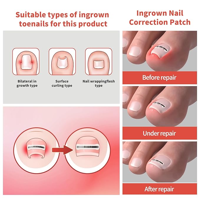 Ingrown Toenail Treatment, 10 packs Titanium Alloy Ingrown Toenail Corrector for all size foot, Ingrown Toenail Removal Kit for Curved Nail Repair, at Home Nail Kit Tools-Q03